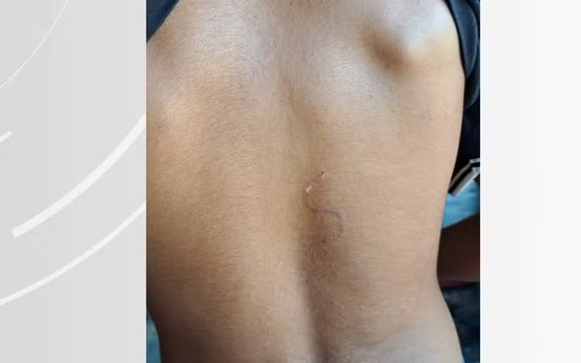 Indígena de 15 anos é queimado com marca de gado enquanto ajudava a cuidar de rebanho; vaqueiro é suspeito